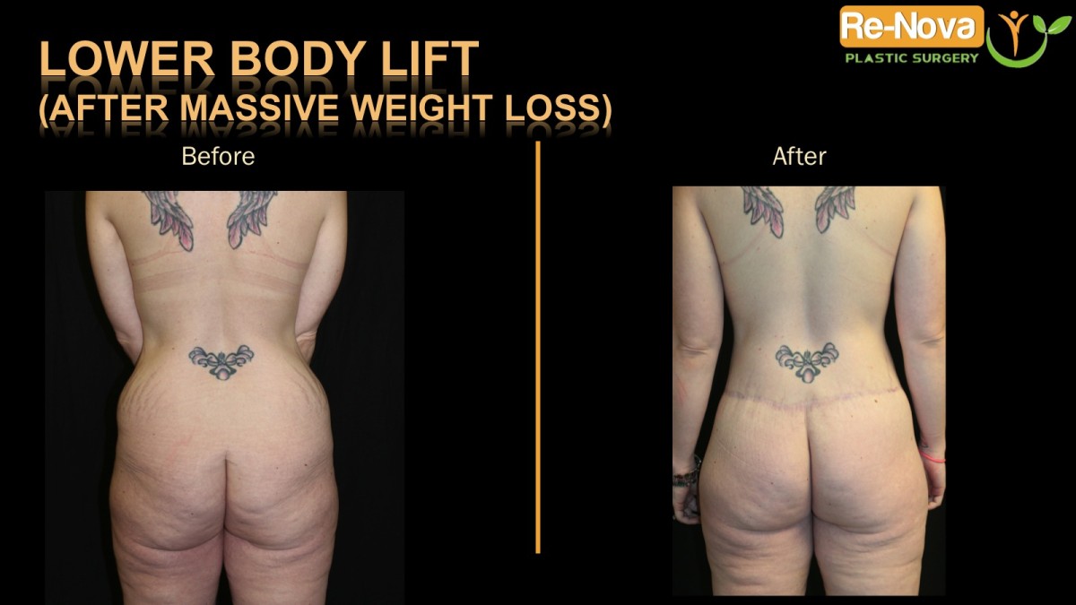 Buttock-lift-Lower-body-lift1-ReNova-Julio-Clavijo-cosmetic-surgery-surgery-before-and-after-pictures-prices-costs-financing-american-society-of-plastic-surgeons-board-certified-Best-TopWexford-Butler-Pittsburgh-Murrysville-Monroeville-Allegheny-Greensburg-Westmoreland-Johnstown-Altoona-(Western-PA)-Youngstown-(OH)-Wheeling-Morgantown-(WV)
