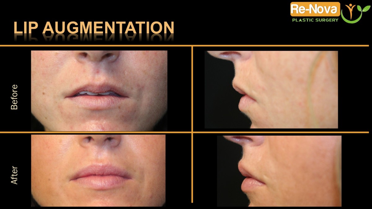 Lip-Augmentation-juvaderm-ReNova-Julio-Clavijo-cosmetic-surgery-surgery-before-and-after-pictures-prices-costs-financing-american-society-of-plastic-surgeons-board-certified-Best-TopWexford-Butler-Pittsburgh-Murrysville-Monroeville-Allegheny-Greensburg-Westmoreland-Johnstown-Altoona-(Western-PA)-Youngstown-(OH)-Wheeling-Morgantown-(WV)