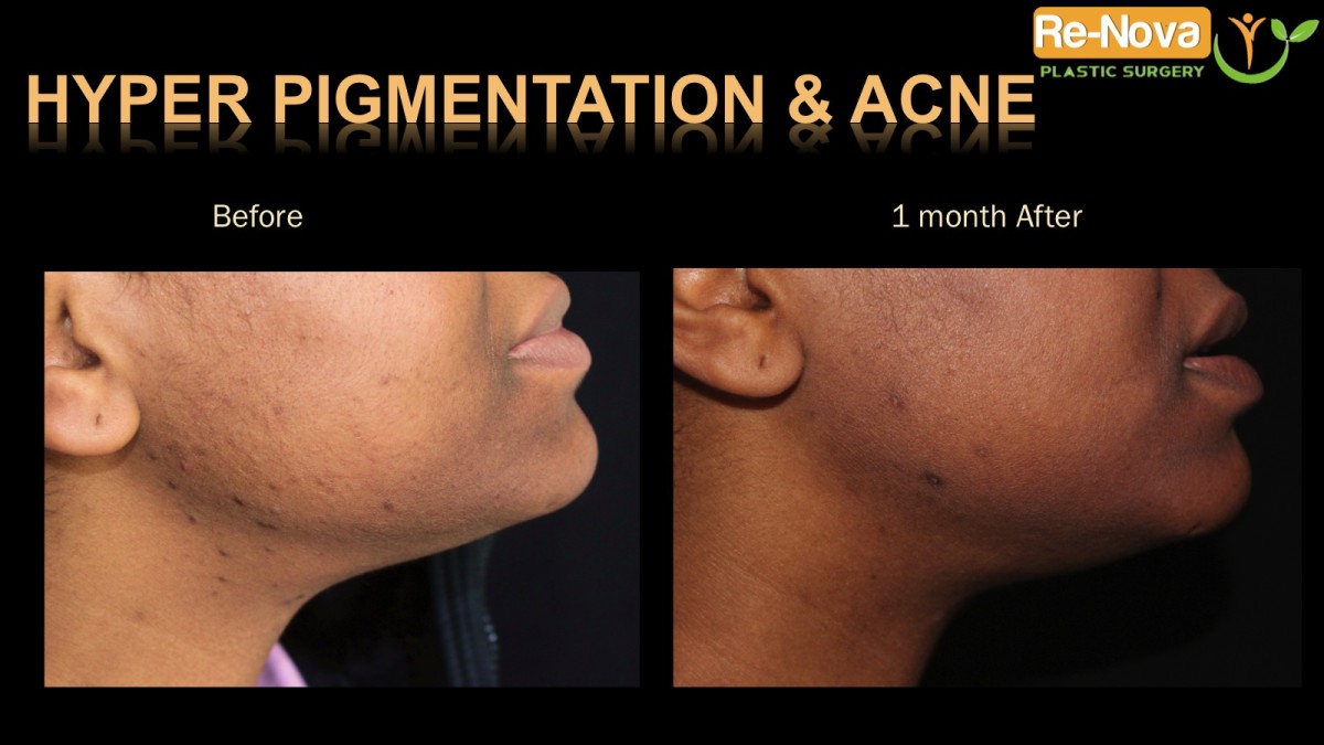 hyperpigmentation-acne1-ReNova-Julio-Clavijo-cosmetic-surgery-surgery-before-and-after-pictures-prices-costs-financing-american-society-of-plastic-surgeons-board-certified-Best-TopWexford-Butler-Pittsburgh-Murrysville-Monroeville-Allegheny-Greensburg-Westmoreland-Johnstown-Altoona-(Western-PA)-Youngstown-(OH)-Wheeling-Morgantown-(WV)