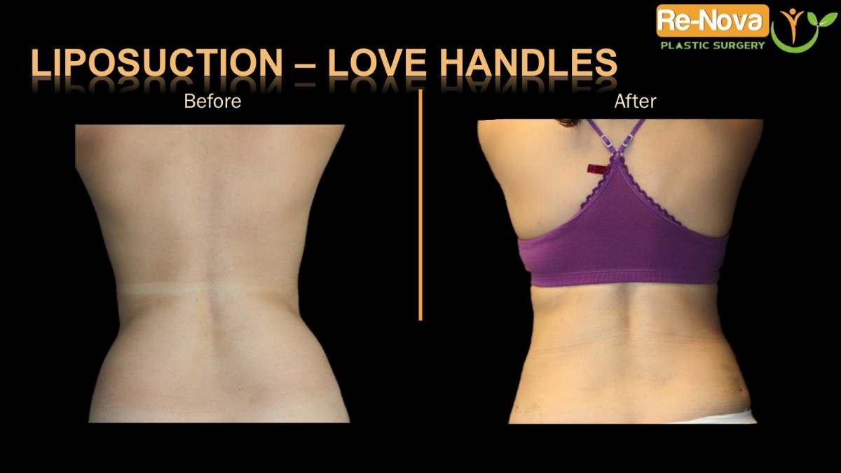 liposuction-Love handles1-ReNova-Julio-Clavijo-cosmetic-surgery-surgery-before-and-after-pictures-prices-costs-financing-american-society-of-plastic-surgeons-board-certified-Best-TopWexford-Butler-Pittsburgh-Murrysville-Monroeville-Allegheny-Greensburg-Westmoreland-Johnstown-Altoona-(Western-PA)-Youngstown-(OH)-Wheeling-Morgantown-(WV)