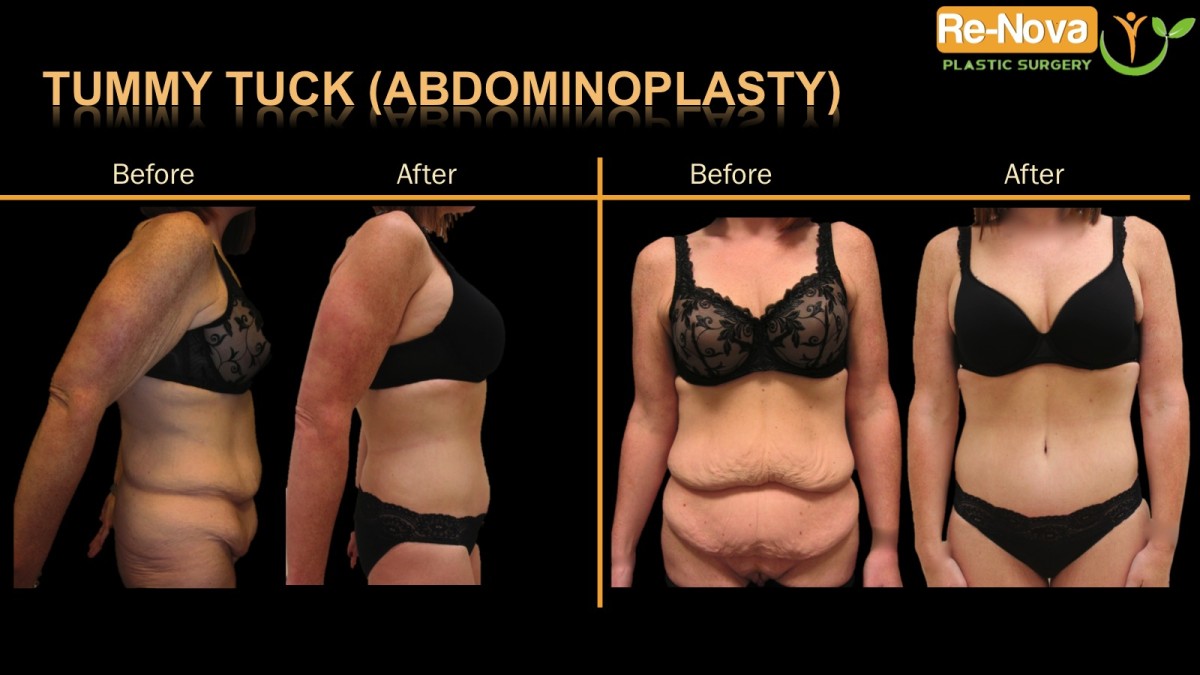 Abdominoplasty-tummy-tuck-1-ReNova-Julio-Clavijo-cosmetic-surgery-surgery-before-and-after-pictures-prices-costs-financing-american-society-of-plastic-surgeons-board-certified-Best-TopWexford-Butler-Pittsburgh-Murrysville-Monroeville-Allegheny-Greensburg-Westmoreland-Johnstown-Altoona-(Western-PA)-Youngstown-(OH)-Wheeling-Morgantown-(WV)