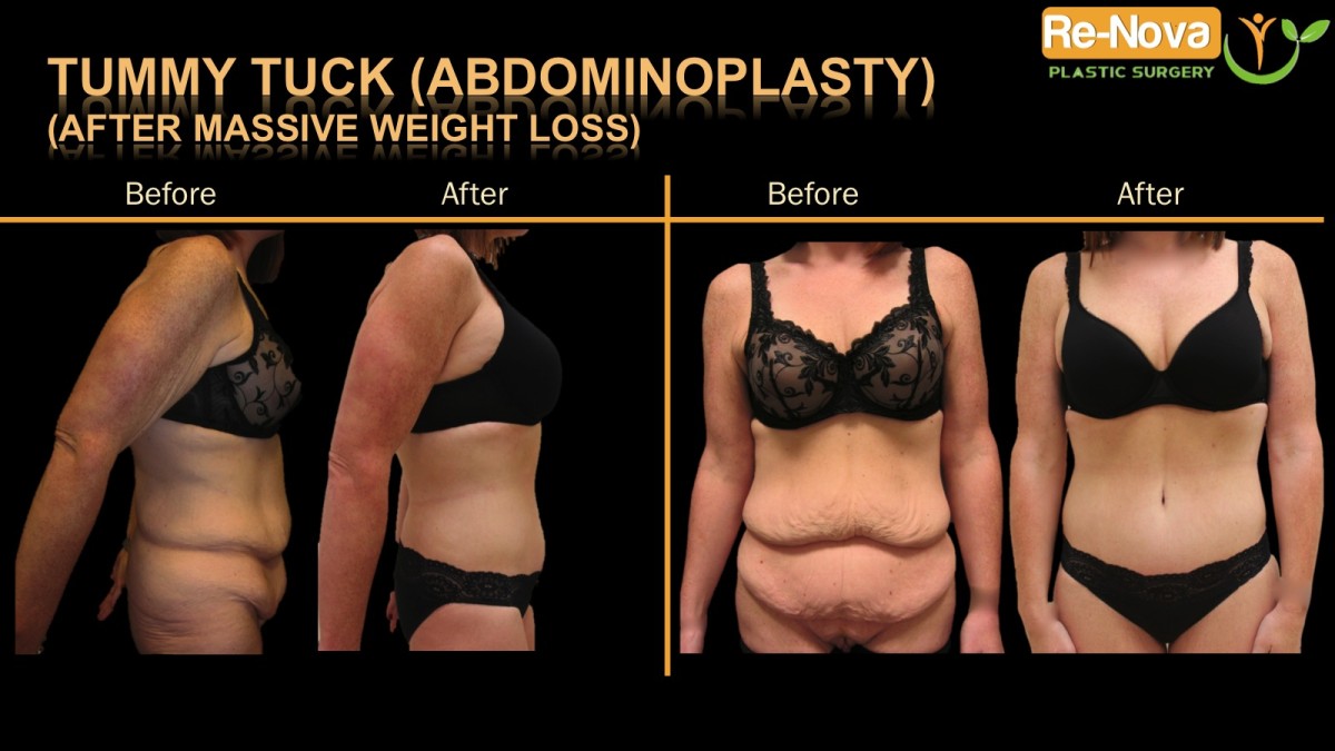 Abdominoplasty-tummy-tuck-1-ReNova-Julio-Clavijo-cosmetic-surgery-surgery-before-and-after-pictures-prices-costs-financing-american-society-of-plastic-surgeons-board-certified-Best-TopWexford-Butler-Pittsburgh-Murrysville-Monroeville-Allegheny-Greensburg-Westmoreland-Johnstown-Altoona-(Western-PA)-Youngstown-(OH)-Wheeling-Morgantown-(WV)