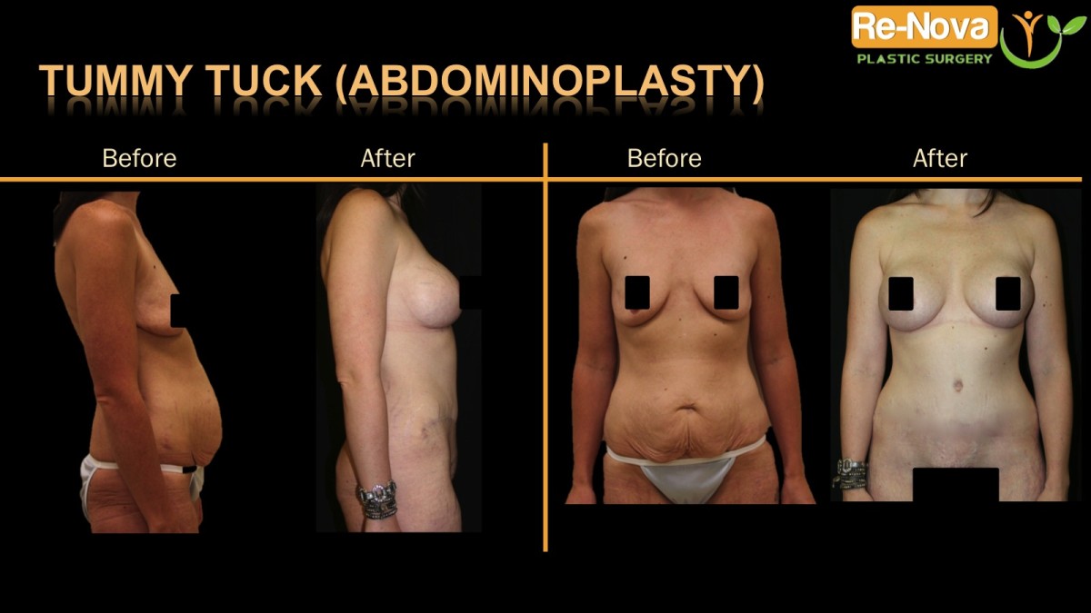 Abdominoplasty-tummy-tuck-2-ReNova-Julio-Clavijo-cosmetic-surgery-surgery-before-and-after-pictures-prices-costs-financing-american-society-of-plastic-surgeons-board-certified-Best-TopWexford-Butler-Pittsburgh-Murrysville-Monroeville-Allegheny-Greensburg-Westmoreland-Johnstown-Altoona-(Western-PA)-Youngstown-(OH)-Wheeling-Morgantown-(WV)