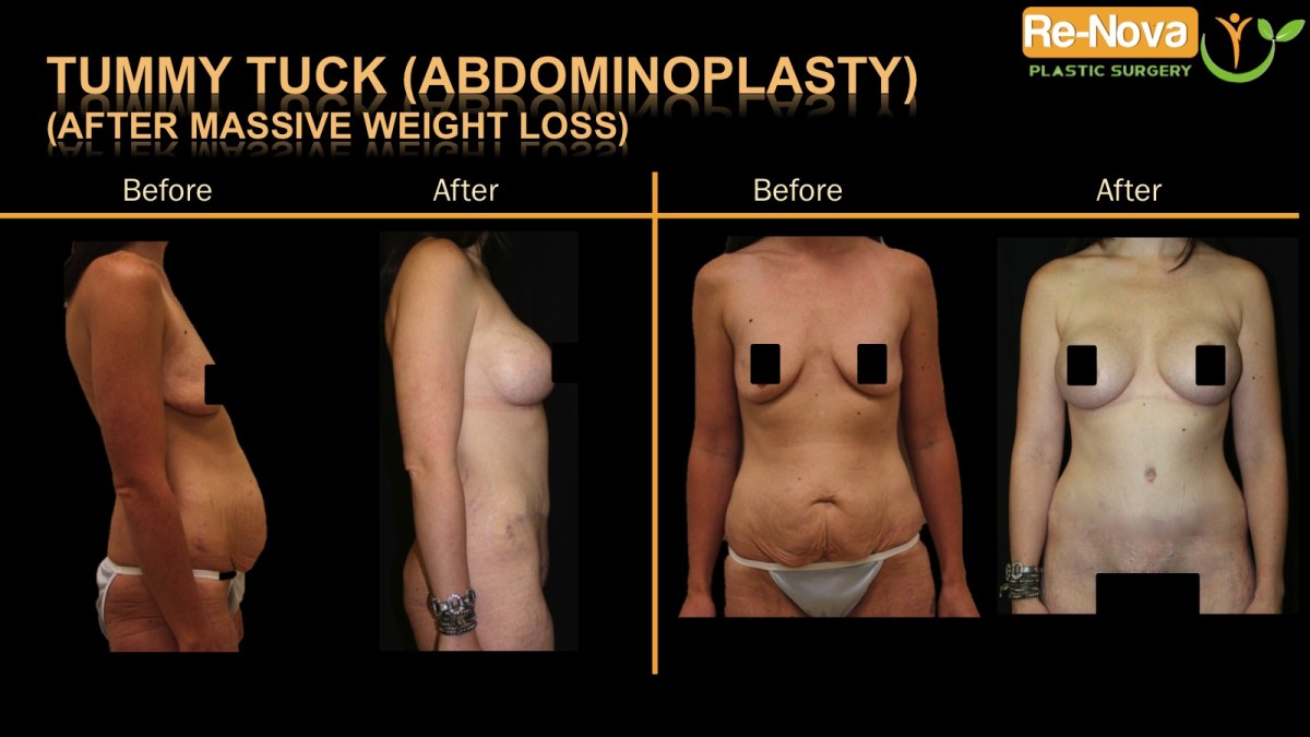 Abdominoplasty-tummy-tuck-2-ReNova-Julio-Clavijo-cosmetic-surgery-surgery-before-and-after-pictures-prices-costs-financing-american-society-of-plastic-surgeons-board-certified-Best-TopWexford-Butler-Pittsburgh-Murrysville-Monroeville-Allegheny-Greensburg-Westmoreland-Johnstown-Altoona-(Western-PA)-Youngstown-(OH)-Wheeling-Morgantown-(WV)
