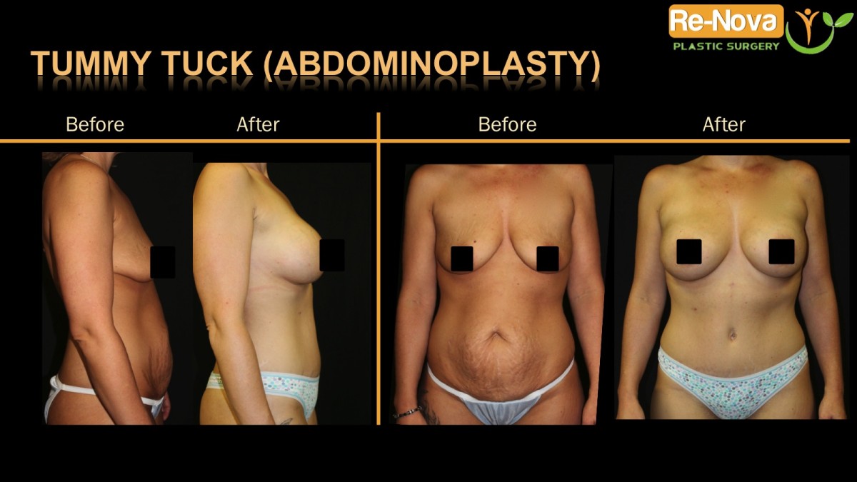 Abdominoplasty-tummy-tuck-3-ReNova-Julio-Clavijo-cosmetic-surgery-surgery-before-and-after-pictures-prices-costs-financing-american-society-of-plastic-surgeons-board-certified-Best-TopWexford-Butler-Pittsburgh-Murrysville-Monroeville-Allegheny-Greensburg-Westmoreland-Johnstown-Altoona-(Western-PA)-Youngstown-(OH)-Wheeling-Morgantown-(WV)