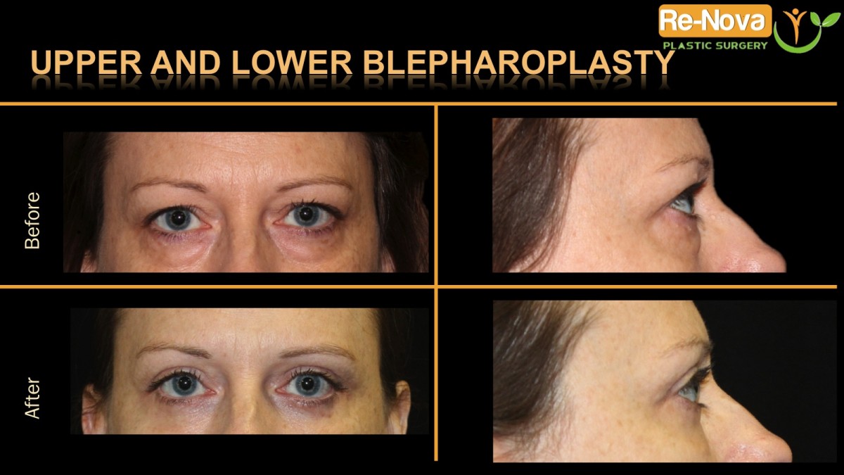 Blepharoplasty-eyelid-surgery1-ReNova-Julio-Clavijo-cosmetic-surgery-surgery-before-and-after-pictures-prices-costs-financing-american-society-of-plastic-surgeons-board-certified-Best-TopWexford-Butler-Pittsburgh-Murrysville-Monroeville-Allegheny-Greensburg-Westmoreland-Johnstown-Altoona-(Western-PA)-Youngstown-(OH)-Wheeling-Morgantown-(WV)
