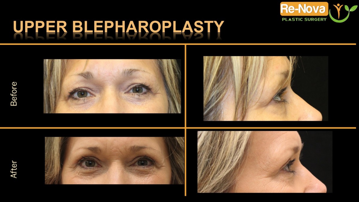 Blepharoplasty-eyelid-surgery2-ReNova-Julio-Clavijo-cosmetic-surgery-surgery-before-and-after-pictures-prices-costs-financing-american-society-of-plastic-surgeons-board-certified-Best-TopWexford-Butler-Pittsburgh-Murrysville-Monroeville-Allegheny-Greensburg-Westmoreland-Johnstown-Altoona-(Western-PA)-Youngstown-(OH)-Wheeling-Morgantown-(WV)