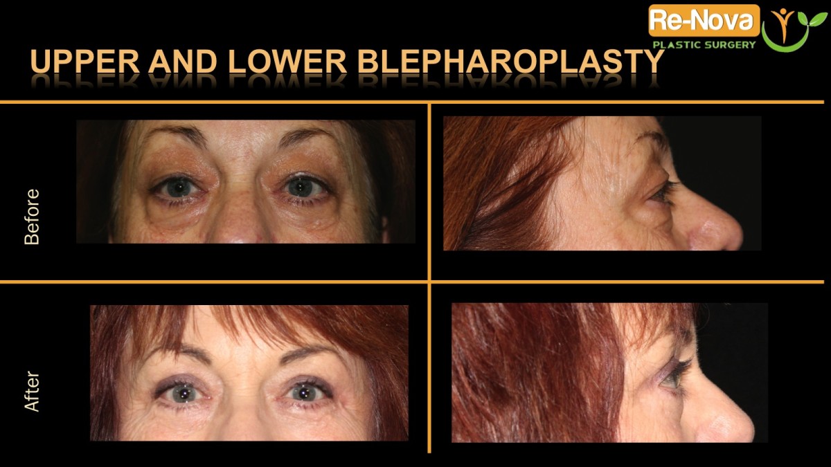 Blepharoplasty-eyelid-surgery3-ReNova-Julio-Clavijo-cosmetic-surgery-surgery-before-and-after-pictures-prices-costs-financing-american-society-of-plastic-surgeons-board-certified-Best-TopWexford-Butler-Pittsburgh-Murrysville-Monroeville-Allegheny-Greensburg-Westmoreland-Johnstown-Altoona-(Western-PA)-Youngstown-(OH)-Wheeling-Morgantown-(WV)