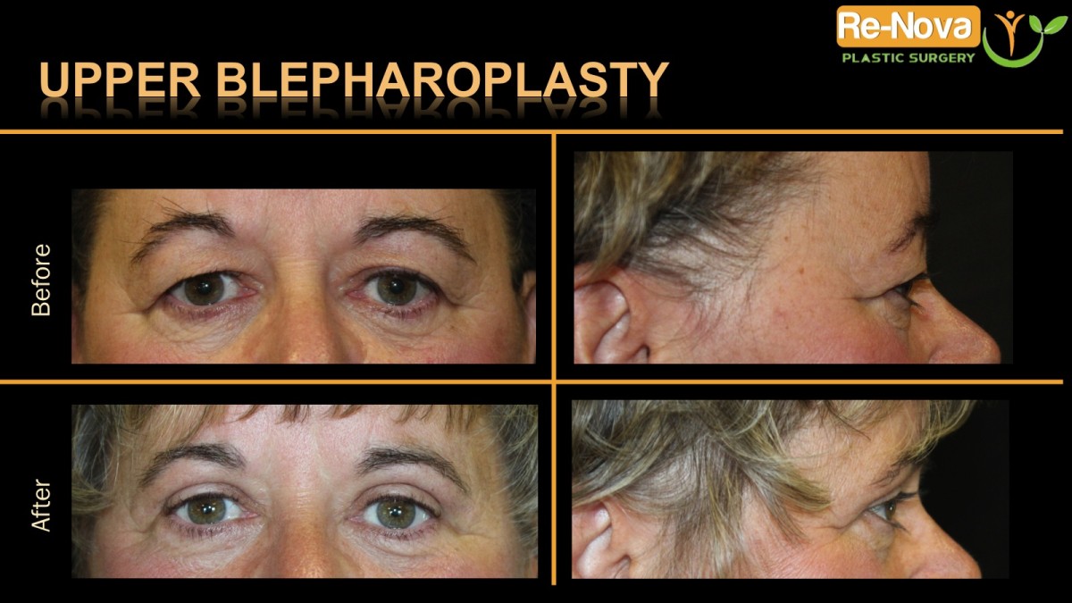 Blepharoplasty-eyelid-surgery4-ReNova-Julio-Clavijo-cosmetic-surgery-surgery-before-and-after-pictures-prices-costs-financing-american-society-of-plastic-surgeons-board-certified-Best-TopWexford-Butler-Pittsburgh-Murrysville-Monroeville-Allegheny-Greensburg-Westmoreland-Johnstown-Altoona-(Western-PA)-Youngstown-(OH)-Wheeling-Morgantown-(WV)
