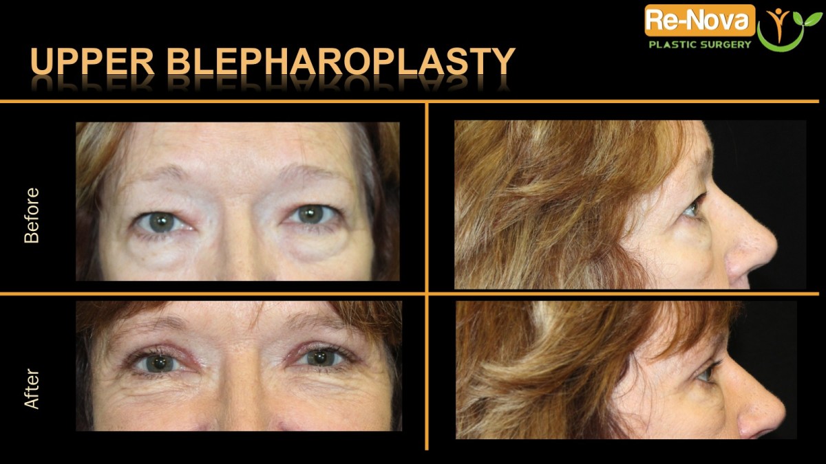 Blepharoplasty-eyelid-surgery5-ReNova-Julio-Clavijo-cosmetic-surgery-surgery-before-and-after-pictures-prices-costs-financing-american-society-of-plastic-surgeons-board-certified-Best-TopWexford-Butler-Pittsburgh-Murrysville-Monroeville-Allegheny-Greensburg-Westmoreland-Johnstown-Altoona-(Western-PA)-Youngstown-(OH)-Wheeling-Morgantown-(WV)