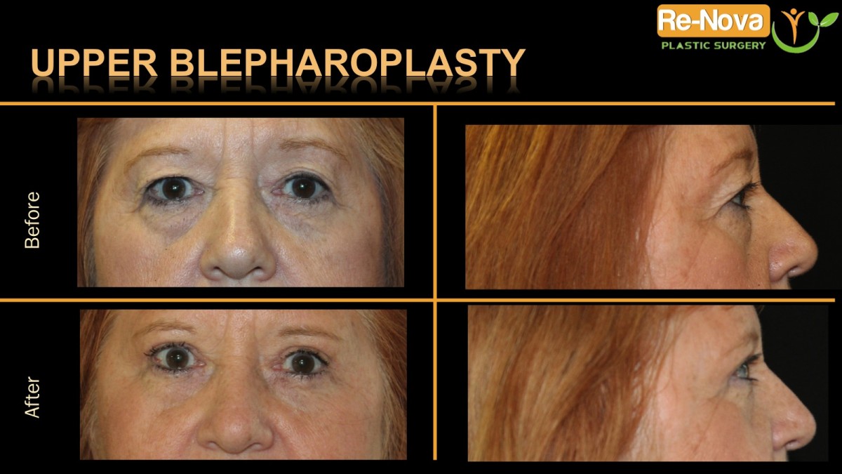 Blepharoplasty-eyelid-surgery6-ReNova-Julio-Clavijo-cosmetic-surgery-surgery-before-and-after-pictures-prices-costs-financing-american-society-of-plastic-surgeons-board-certified-Best-TopWexford-Butler-Pittsburgh-Murrysville-Monroeville-Allegheny-Greensburg-Westmoreland-Johnstown-Altoona-(Western-PA)-Youngstown-(OH)-Wheeling-Morgantown-(WV)