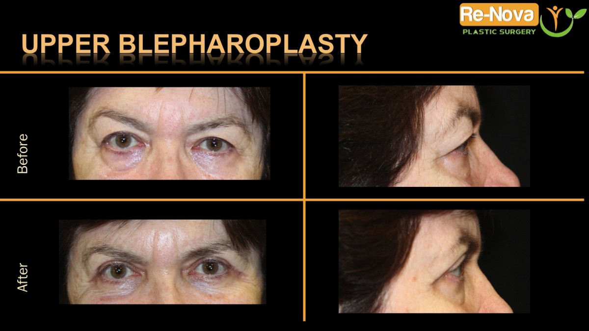 Blepharoplasty-eyelid-surgery7-ReNova-Julio-Clavijo-cosmetic-surgery-surgery-before-and-after-pictures-prices-costs-financing-american-society-of-plastic-surgeons-board-certified-Best-TopWexford-Butler-Pittsburgh-Murrysville-Monroeville-Allegheny-Greensburg-Westmoreland-Johnstown-Altoona-(Western-PA)-Youngstown-(OH)-Wheeling-Morgantown-(WV)