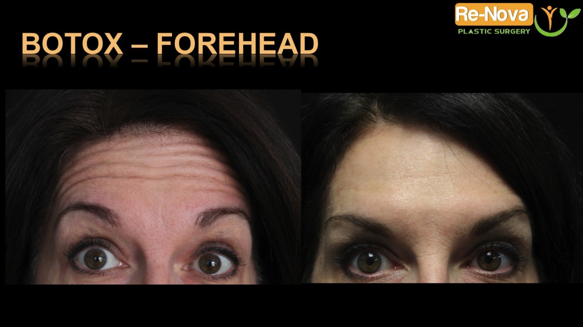 Botox-forehead1-Pittsburgh-ReNova-Julio-Clavijo-cosmetic-surgery-surgery-before-and-after-pictures-prices-costs-financing-american-society-of-plastic-surgeons-board-certified-Best-TopWexford-Butler-Pittsburgh-Murrysville-Monroeville-Allegheny-Greensburg-Westmoreland-Johnstown-Altoona-(Western-PA)-Youngstown-(OH)-Wheeling-Morgantown-(WV)