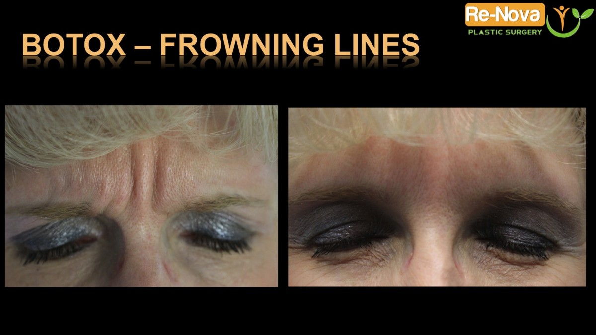 Botox-frowning-lines1-ReNova-Julio-Clavijo-cosmetic-surgery-surgery-before-and-after-pictures-prices-costs-financing-american-society-of-plastic-surgeons-board-certified-Best-TopWexford-Butler-Pittsburgh-Murrysville-Monroeville-Allegheny-Greensburg-Westmoreland-Johnstown-Altoona-(Western-PA)-Youngstown-(OH)-Wheeling-Morgantown-(WV)