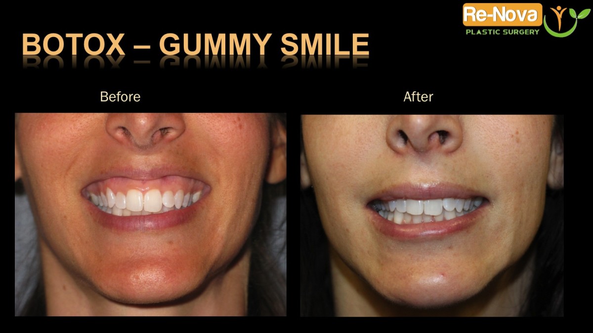 Botox-gummy-smile1-ReNova-Julio-Clavijo-cosmetic-surgery-surgery-before-and-after-pictures-prices-costs-financing-american-society-of-plastic-surgeons-board-certified-Best-TopWexford-Butler-Pittsburgh-Murrysville-Monroeville-Allegheny-Greensburg-Westmoreland-Johnstown-Altoona-(Western-PA)-Youngstown-(OH)-Wheeling-Morgantown-(WV)
