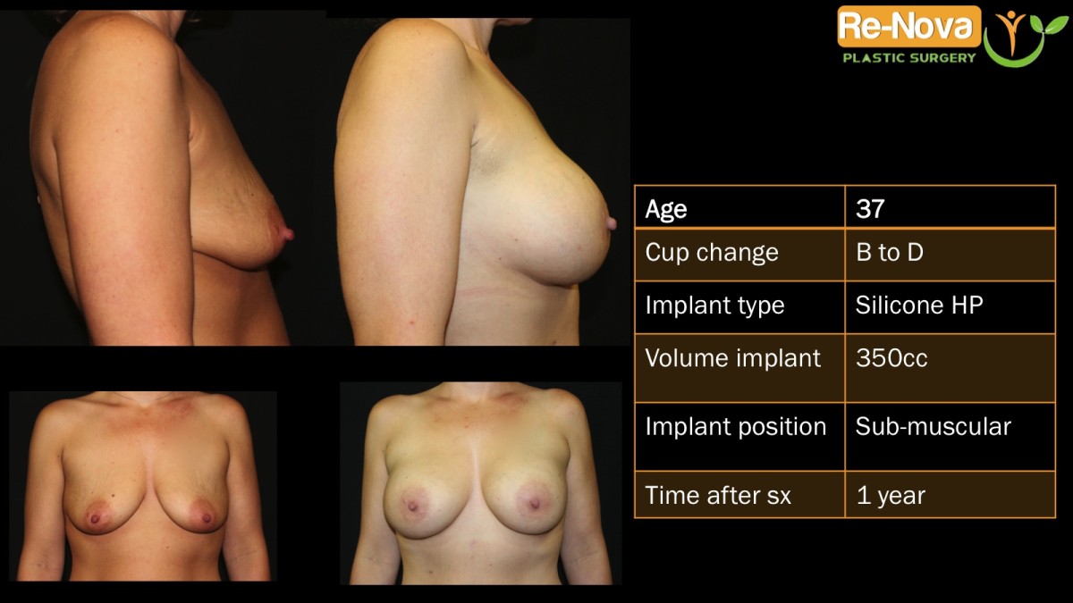 Breast-Augmentation1-ReNova-Julio-Clavijo-cosmetic-surgery-surgery-before-and-after-pictures-prices-costs-financing-american-society-of-plastic-surgeons-board-certified-Best-TopWexford-Butler-Pittsburgh-Murrysville-Monroeville-Allegheny-Greensburg-Westmoreland-Johnstown-Altoona-(Western-PA)-Youngstown-(OH)-Wheeling-Morgantown-(WV)