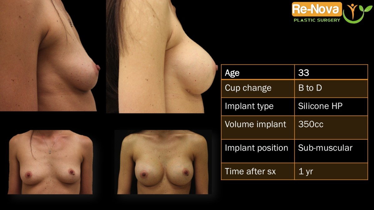 Breast-Augmentation2-ReNova-Julio-Clavijo-cosmetic-surgery-surgery-before-and-after-pictures-prices-costs-financing-american-society-of-plastic-surgeons-board-certified-Best-TopWexford-Butler-Pittsburgh-Murrysville-Monroeville-Allegheny-Greensburg-Westmoreland-Johnstown-Altoona-(Western-PA)-Youngstown-(OH)-Wheeling-Morgantown-(WV)