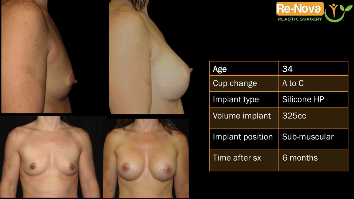 Breast-Augmentation3-ReNova-Julio-Clavijo-cosmetic-surgery-surgery-before-and-after-pictures-prices-costs-financing-american-society-of-plastic-surgeons-board-certified-Best-TopWexford-Butler-Pittsburgh-Murrysville-Monroeville-Allegheny-Greensburg-Westmoreland-Johnstown-Altoona-(Western-PA)-Youngstown-(OH)-Wheeling-Morgantown-(WV)