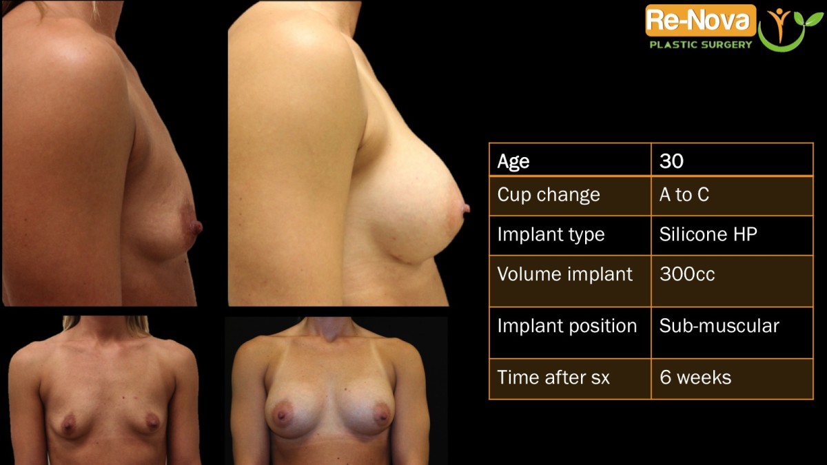 Breast-Augmentation4-ReNova-Julio-Clavijo-cosmetic-surgery-surgery-before-and-after-pictures-prices-costs-financing-american-society-of-plastic-surgeons-board-certified-Best-TopWexford-Butler-Pittsburgh-Murrysville-Monroeville-Allegheny-Greensburg-Westmoreland-Johnstown-Altoona-(Western-PA)-Youngstown-(OH)-Wheeling-Morgantown-(WV)