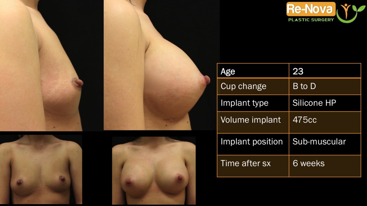 Breast-Augmentation5-ReNova-Julio-Clavijo-cosmetic-surgery-surgery-before-and-after-pictures-prices-costs-financing-american-society-of-plastic-surgeons-board-certified-Best-TopWexford-Butler-Pittsburgh-Murrysville-Monroeville-Allegheny-Greensburg-Westmoreland-Johnstown-Altoona-(Western-PA)-Youngstown-(OH)-Wheeling-Morgantown-(WV)