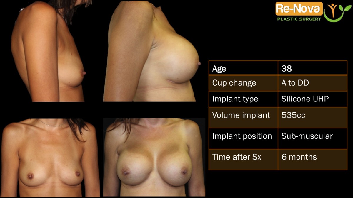 Breast-Augmentation6-ReNova-Julio-Clavijo-cosmetic-surgery-surgery-before-and-after-pictures-prices-costs-financing-american-society-of-plastic-surgeons-board-certified-Best-TopWexford-Butler-Pittsburgh-Murrysville-Monroeville-Allegheny-Greensburg-Westmoreland-Johnstown-Altoona-(Western-PA)-Youngstown-(OH)-Wheeling-Morgantown-(WV)