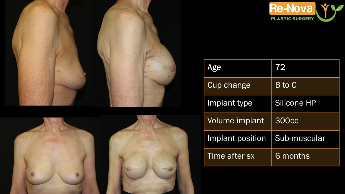 Breast-Reconstruction1-ReNova-Julio-Clavijo-cosmetic-surgery-surgery-before-and-after-pictures-prices-costs-financing-american-society-of-plastic-surgeons-board-certified-Best-TopWexford-Butler-Pittsburgh-Murrysville-Monroeville-Allegheny-Greensburg-Westmoreland-Johnstown-Altoona-(Western-PA)-Youngstown-(OH)-Wheeling-Morgantown-(WV)