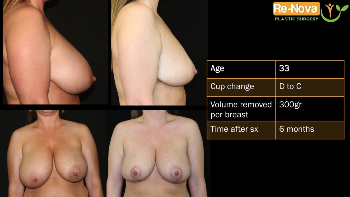 Breast-Reduction1-ReNova-Julio-Clavijo-cosmetic-surgery-surgery-before-and-after-pictures-prices-costs-financing-american-society-of-plastic-surgeons-board-certified-Best-TopWexford-Butler-Pittsburgh-Murrysville-Monroeville-Allegheny-Greensburg-Westmoreland-Johnstown-Altoona-(Western-PA)-Youngstown-(OH)-Wheeling-Morgantown-(WV)