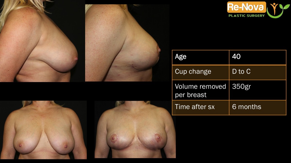 Breast-Reduction3-ReNova-Julio-Clavijo-cosmetic-surgery-surgery-before-and-after-pictures-prices-costs-financing-american-society-of-plastic-surgeons-board-certified-Best-TopWexford-Butler-Pittsburgh-Murrysville-Monroeville-Allegheny-Greensburg-Westmoreland-Johnstown-Altoona-(Western-PA)-Youngstown-(OH)-Wheeling-Morgantown-(WV)