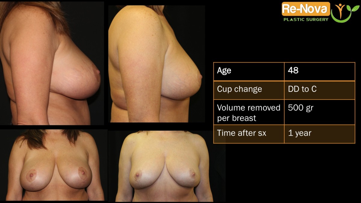Breast-Reduction4-ReNova-Julio-Clavijo-cosmetic-surgery-surgery-before-and-after-pictures-prices-costs-financing-american-society-of-plastic-surgeons-board-certified-Best-TopWexford-Butler-Pittsburgh-Murrysville-Monroeville-Allegheny-Greensburg-Westmoreland-Johnstown-Altoona-(Western-PA)-Youngstown-(OH)-Wheeling-Morgantown-(WV)