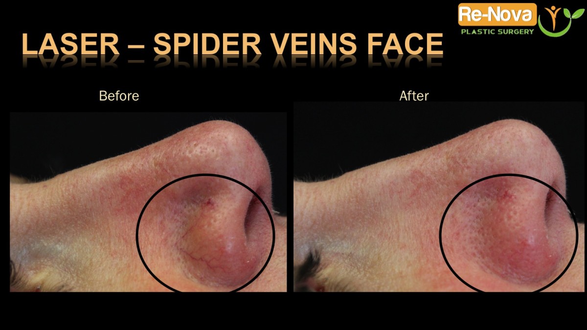 LASER-Spider-veins-face1-ReNova-Julio-Clavijo-cosmetic-surgery-surgery-before-and-after-pictures-prices-costs-financing-american-society-of-plastic-surgeons-board-certified-Best-TopWexford-Butler-Pittsburgh-Murrysville-Monroeville-Allegheny-Greensburg-Westmoreland-Johnstown-Altoona-(Western-PA)-Youngstown-(OH)-Wheeling-Morgantown-(WV)