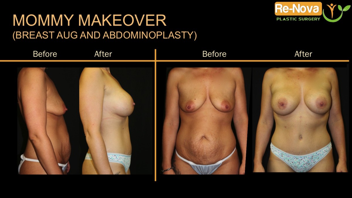 Mommy-makeover1-ReNova-Julio-Clavijo-cosmetic-surgery-surgery-before-and-after-pictures-prices-costs-financing-american-society-of-plastic-surgeons-board-certified-Best-TopWexford-Butler-Pittsburgh-Murrysville-Monroeville-Allegheny-Greensburg-Westmoreland-Johnstown-Altoona-(Western-PA)-Youngstown-(OH)-Wheeling-Morgantown-(WV)