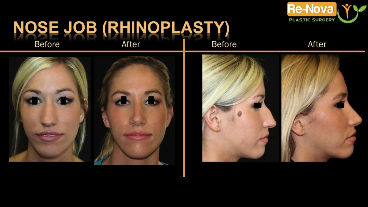 Rhinoplasty-nosejob1-ReNova-Julio-Clavijo-cosmetic-surgery-surgery-before-and-after-pictures-prices-costs-financing-american-society-of-plastic-surgeons-board-certified-Best-TopWexford-Butler-Pittsburgh-Murrysville-Monroeville-Allegheny-Greensburg-Westmoreland-Johnstown-Altoona-(Western-PA)-Youngstown-(OH)-Wheeling-Morgantown-(WV)