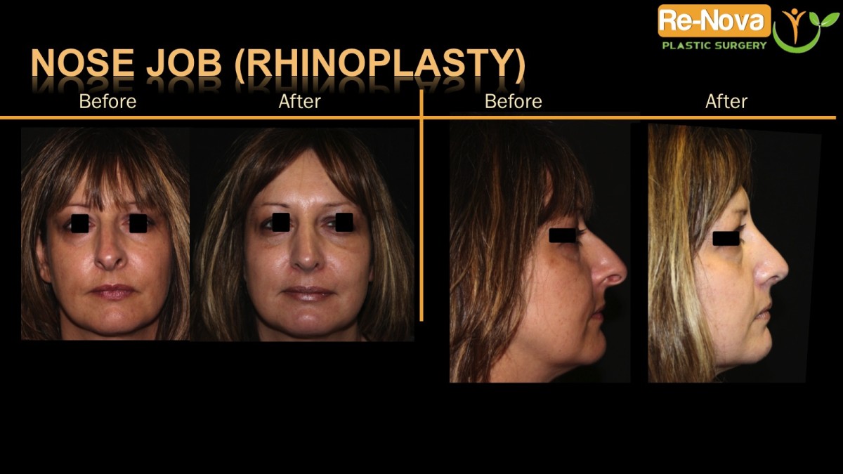 Rhinoplasty-nosejob2-ReNova-Julio-Clavijo-cosmetic-surgery-surgery-before-and-after-pictures-prices-costs-financing-american-society-of-plastic-surgeons-board-certified-Best-TopWexford-Butler-Pittsburgh-Murrysville-Monroeville-Allegheny-Greensburg-Westmoreland-Johnstown-Altoona-(Western-PA)-Youngstown-(OH)-Wheeling-Morgantown-(WV)