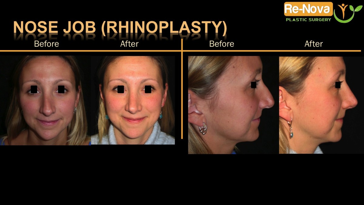 Rhinoplasty-nosejob3-ReNova-Julio-Clavijo-cosmetic-surgery-surgery-before-and-after-pictures-prices-costs-financing-american-society-of-plastic-surgeons-board-certified-Best-TopWexford-Butler-Pittsburgh-Murrysville-Monroeville-Allegheny-Greensburg-Westmoreland-Johnstown-Altoona-(Western-PA)-Youngstown-(OH)-Wheeling-Morgantown-(WV)