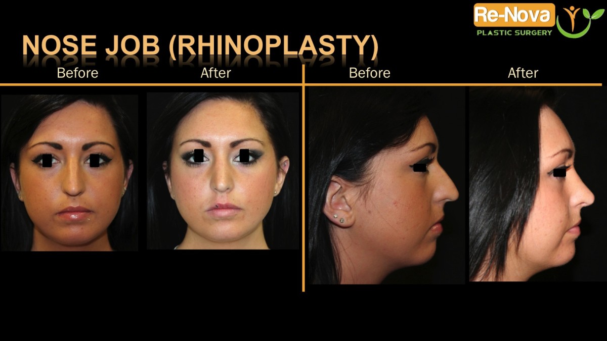 Rhinoplasty-nosejob4-ReNova-Julio-Clavijo-cosmetic-surgery-surgery-before-and-after-pictures-prices-costs-financing-american-society-of-plastic-surgeons-board-certified-Best-TopWexford-Butler-Pittsburgh-Murrysville-Monroeville-Allegheny-Greensburg-Westmoreland-Johnstown-Altoona-(Western-PA)-Youngstown-(OH)-Wheeling-Morgantown-(WV)