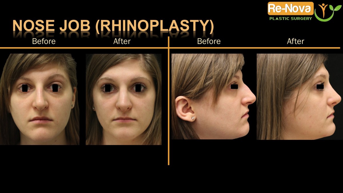 Rhinoplasty-nosejob5-ReNova-Julio-Clavijo-cosmetic-surgery-surgery-before-and-after-pictures-prices-costs-financing-american-society-of-plastic-surgeons-board-certified-Best-TopWexford-Butler-Pittsburgh-Murrysville-Monroeville-Allegheny-Greensburg-Westmoreland-Johnstown-Altoona-(Western-PA)-Youngstown-(OH)-Wheeling-Morgantown-(WV)