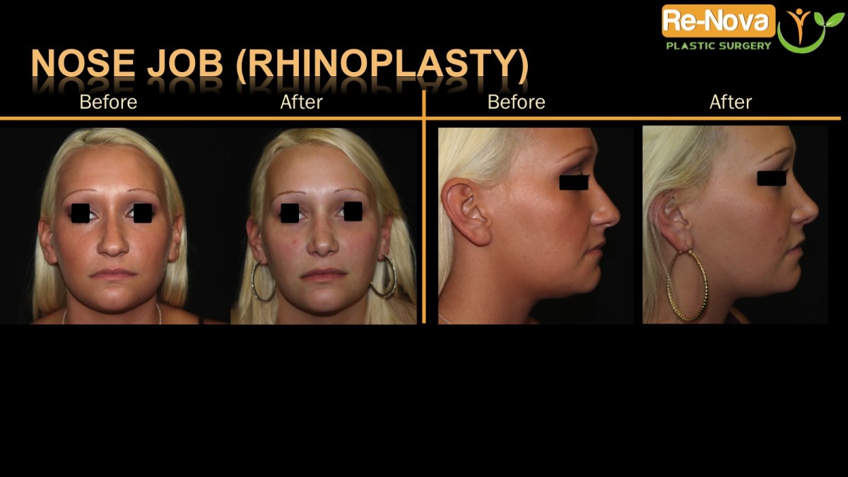 Rhinoplasty-nosejob6-ReNova-Julio-Clavijo-cosmetic-surgery-surgery-before-and-after-pictures-prices-costs-financing-american-society-of-plastic-surgeons-board-certified-Best-TopWexford-Butler-Pittsburgh-Murrysville-Monroeville-Allegheny-Greensburg-Westmoreland-Johnstown-Altoona-(Western-PA)-Youngstown-(OH)-Wheeling-Morgantown-(WV)