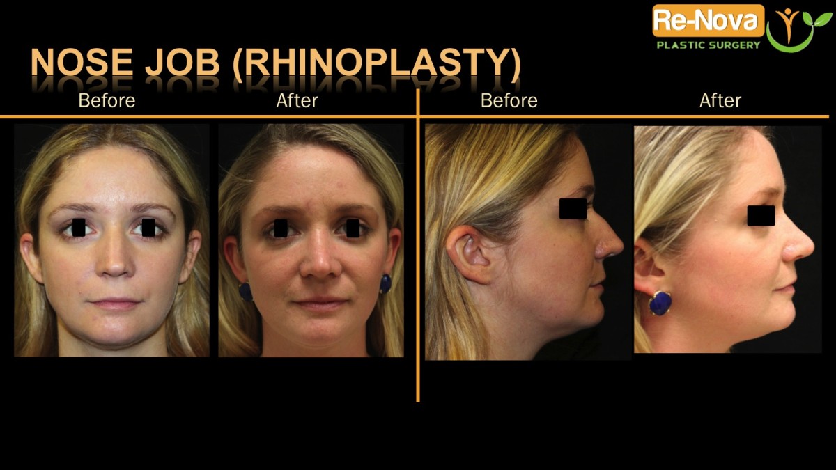 Rhinoplasty-nosejob7-ReNova-Julio-Clavijo-cosmetic-surgery-surgery-before-and-after-pictures-prices-costs-financing-american-society-of-plastic-surgeons-board-certified-Best-TopWexford-Butler-Pittsburgh-Murrysville-Monroeville-Allegheny-Greensburg-Westmoreland-Johnstown-Altoona-(Western-PA)-Youngstown-(OH)-Wheeling-Morgantown-(WV)