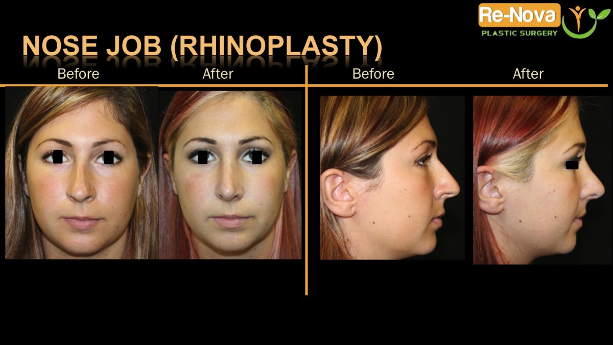 Rhinoplasty-nosejob8-ReNova-Julio-Clavijo-cosmetic-surgery-surgery-before-and-after-pictures-prices-costs-financing-american-society-of-plastic-surgeons-board-certified-Best-TopWexford-Butler-Pittsburgh-Murrysville-Monroeville-Allegheny-Greensburg-Westmoreland-Johnstown-Altoona-(Western-PA)-Youngstown-(OH)-Wheeling-Morgantown-(WV)