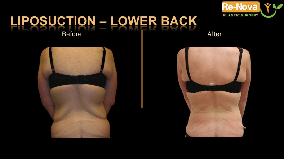 liposuction-back1-ReNova-Julio-Clavijo-cosmetic-surgery-surgery-before-and-after-pictures-prices-costs-financing-american-society-of-plastic-surgeons-board-certified-Best-TopWexford-Butler-Pittsburgh-Murrysville-Monroeville-Allegheny-Greensburg-Westmoreland-Johnstown-Altoona-(Western-PA)-Youngstown-(OH)-Wheeling-Morgantown-(WV)