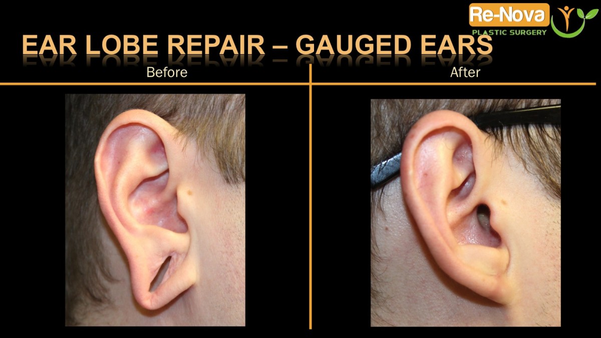 Ear-lobe-repair-gauged1-ReNova-Julio-Clavijo-cosmetic-surgery-surgery-before-and-after-pictures-prices-costs-financing-american-society-of-plastic-surgeons-board-certified-Best-TopWexford-Butler-Pittsburgh-Murrysville-Monroeville-Allegheny-Greensburg-Westmoreland-Johnstown-Altoona-(Western-PA)-Youngstown-(OH)-Wheeling-Morgantown-(WV)