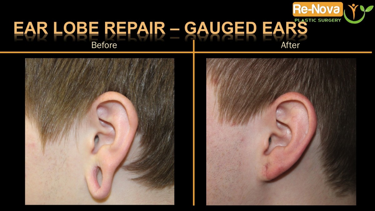 Ear-lobe-repair-gauged2-ReNova-Julio-Clavijo-cosmetic-surgery-surgery-before-and-after-pictures-prices-costs-financing-american-society-of-plastic-surgeons-board-certified-Best-TopWexford-Butler-Pittsburgh-Murrysville-Monroeville-Allegheny-Greensburg-Westmoreland-Johnstown-Altoona-(Western-PA)-Youngstown-(OH)-Wheeling-Morgantown-(WV)