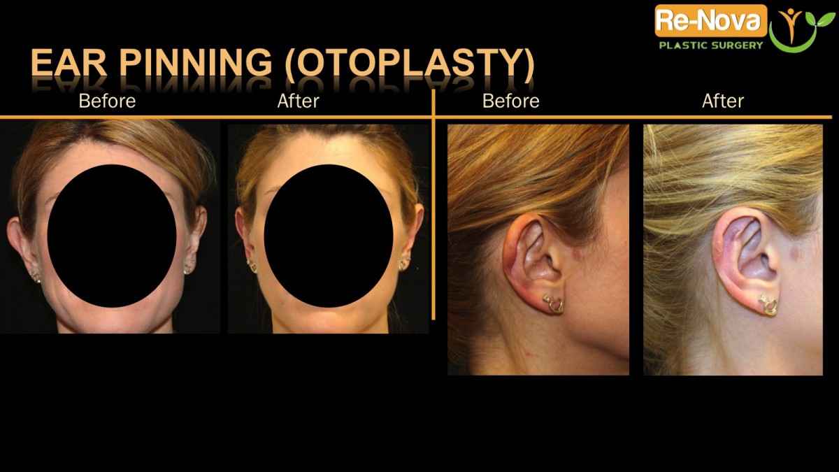 Otoplasty-ear-pinning1-ReNova-Julio-Clavijo-cosmetic-surgery-surgery-before-and-after-pictures-prices-costs-financing-american-society-of-plastic-surgeons-board-certified-Best-TopWexford-Butler-Pittsburgh-Murrysville-Monroeville-Allegheny-Greensburg-Westmoreland-Johnstown-Altoona-(Western-PA)-Youngstown-(OH)-Wheeling-Morgantown-(WV)