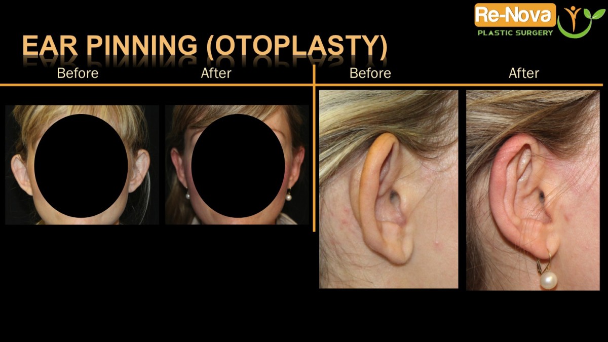 Otoplasty-ear-pinning2-ReNova-Julio-Clavijo-cosmetic-surgery-surgery-before-and-after-pictures-prices-costs-financing-american-society-of-plastic-surgeons-board-certified-Best-TopWexford-Butler-Pittsburgh-Murrysville-Monroeville-Allegheny-Greensburg-Westmoreland-Johnstown-Altoona-(Western-PA)-Youngstown-(OH)-Wheeling-Morgantown-(WV)