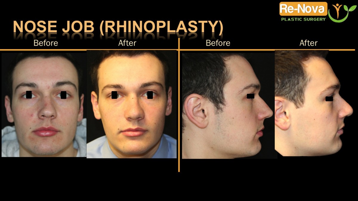 Rhinoplasty-nosejob9-ReNova-Julio-Clavijo-cosmetic-surgery-surgery-before-and-after-pictures-prices-costs-financing-american-society-of-plastic-surgeons-board-certified-Best-TopWexford-Butler-Pittsburgh-Murrysville-Monroeville-Allegheny-Greensburg-Westmoreland-Johnstown-Altoona-(Western-PA)-Youngstown-(OH)-Wheeling-Morgantown-(WV)