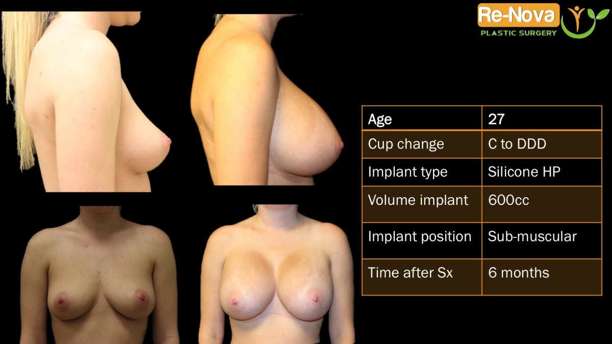 Breast-Augmentation7-ReNova-Julio-Clavijo-cosmetic-surgery-surgery-before-and-after-pictures-prices-costs-financing-american-society-of-plastic-surgeons-board-certified-Best-TopWexford-Butler-Pittsburgh-Murrysville-Monroeville-Allegheny-Greensburg-Westmoreland-Johnstown-Altoona-(Western-PA)-Youngstown-(OH)-Wheeling-Morgantown-(WV)