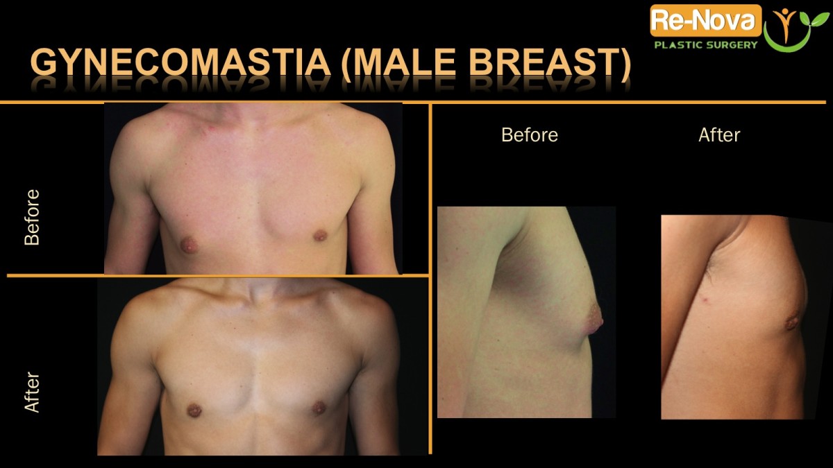 Gynecomastia1-ReNova-Julio-Clavijo-cosmetic-surgery-surgery-before-and-after-pictures-prices-costs-financing-american-society-of-plastic-surgeons-board-certified-Best-TopWexford-Butler-Pittsburgh-Murrysville-Monroeville-Allegheny-Greensburg-Westmoreland-Johnstown-Altoona-(Western-PA)-Youngstown-(OH)-Wheeling-Morgantown-(WV)