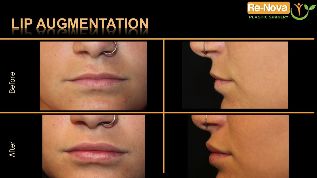 Lip-Augmentation-2-juvaderm-Pittsburgh–Wexford–Monroeville-Greensburg-Ohio-WestVirginia