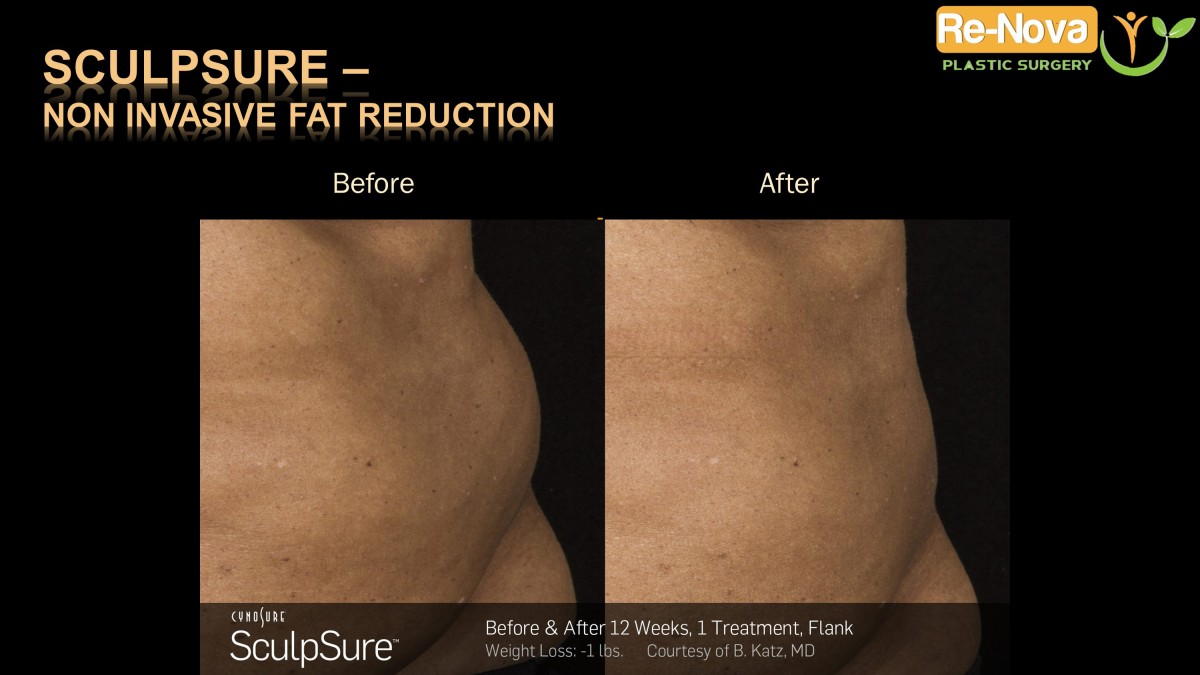 Sculpsure-Non invasive fat reduction-coolsculpting-laser1-ReNova-Julio-Clavijo-Pittsburgh–Wexford–Monroeville-Greensburg-Ohio-WestVirginia