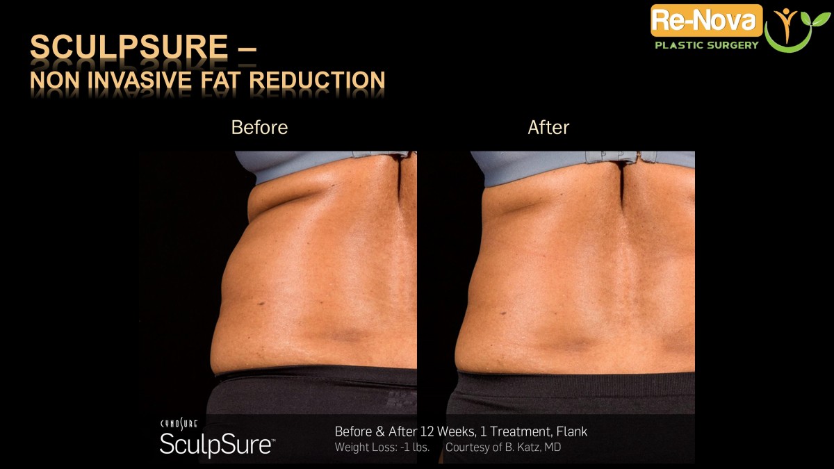 Sculpsure-Non invasive fat reduction-coolsculpting-laser2-ReNova-Julio-Clavijo-Pittsburgh–Wexford–Monroeville-Greensburg-Ohio-WestVirginia